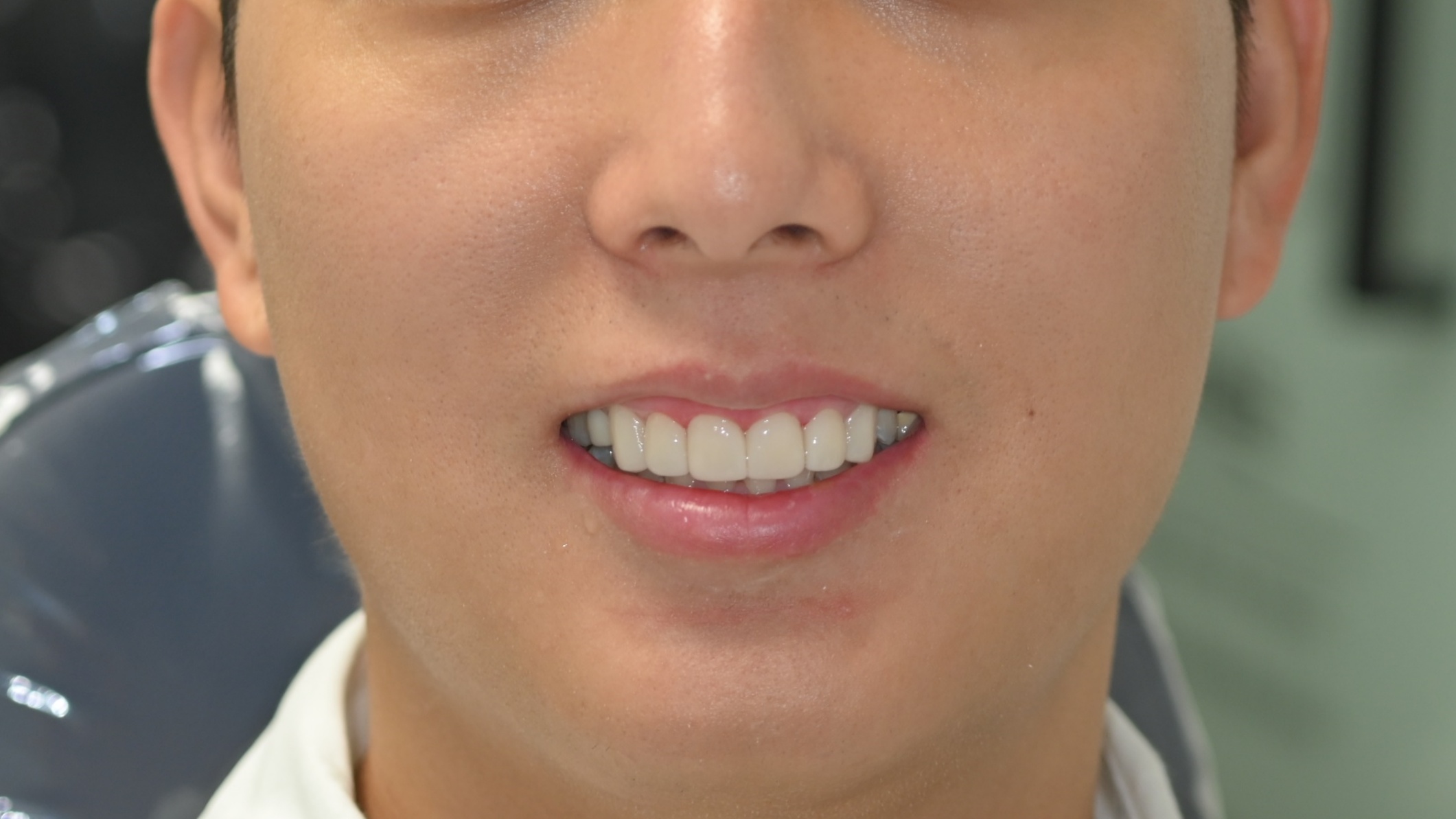 치아 모양 개선 및 미백 미니쉬벨라 6전치